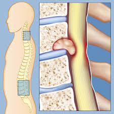 Spinal Tumor Surgery $6500